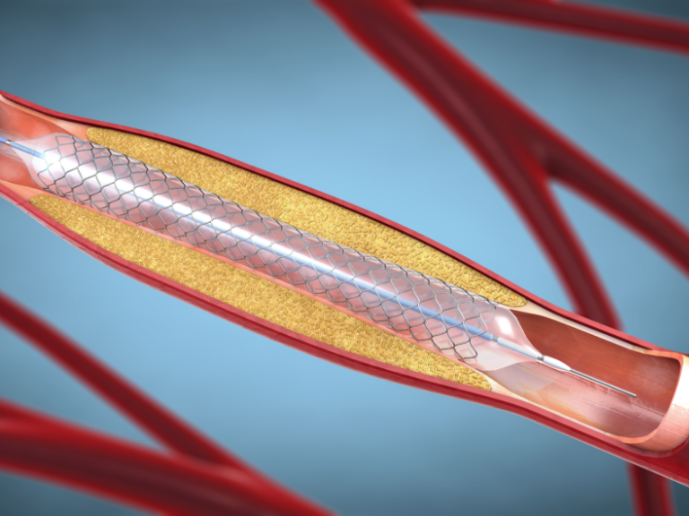 Zeichnung von einem Stent in einem Blutgefäss mit Ablagerungen